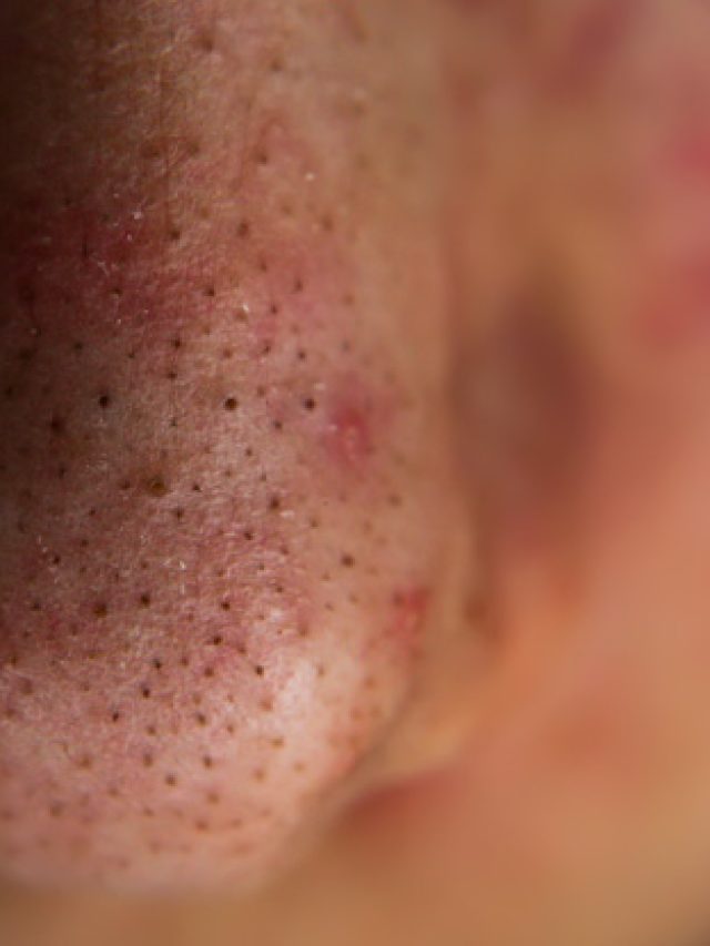 22038-blackheads