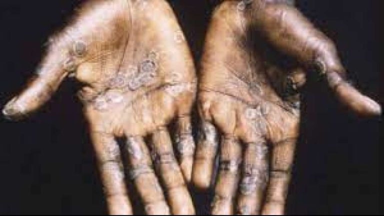 Worried about monkeypox? So get answers to all questions