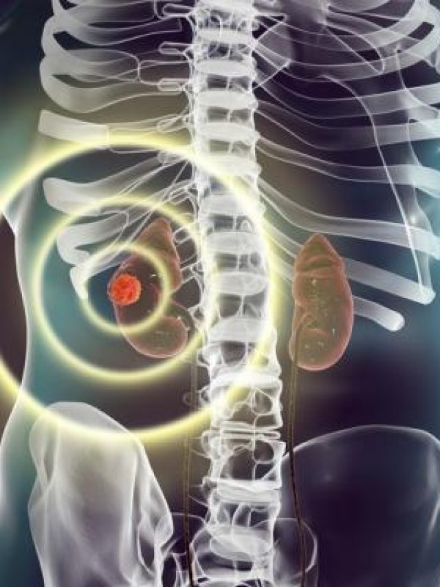 3D-illustration-showing-presence-of-cancerous-tumor-inside-kidney-tissue