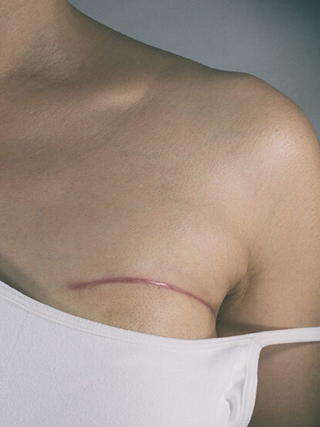 Breast cancer surgery scars
