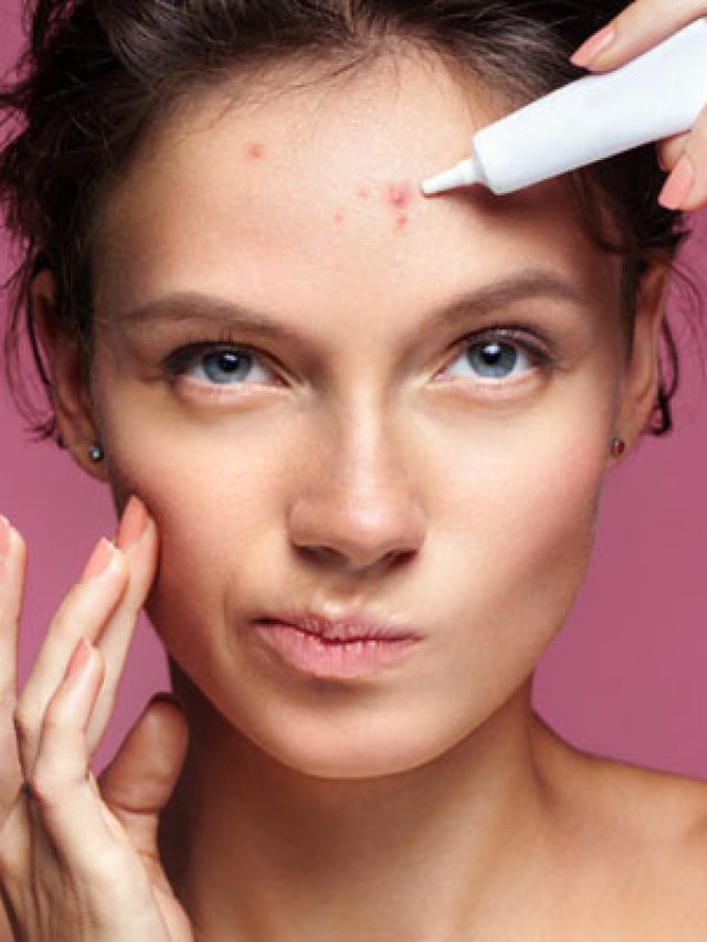 WHAT-CAUSES-PIMPLES-AND-HOW-TO-CURE-THEM_OI