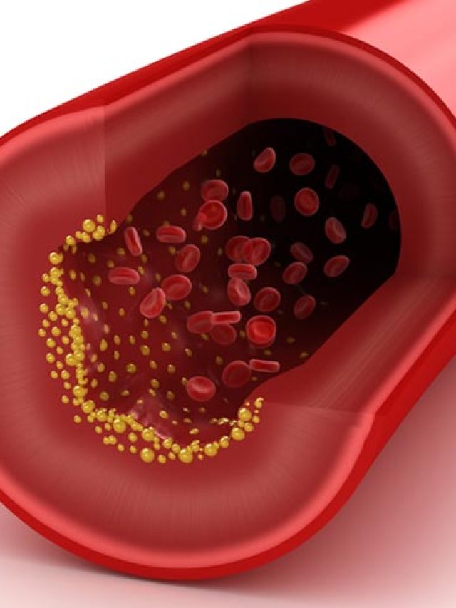 cholesterol_in_artery_750x500