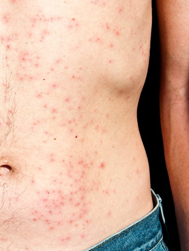 lat-chakatte-red-skin-rash