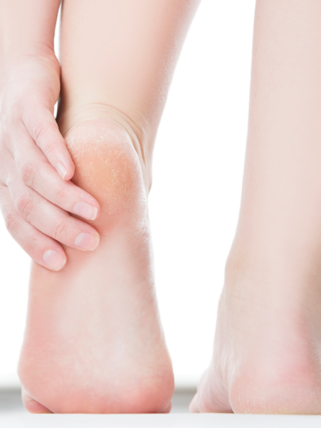 are-your-calluses-actually-a-sign-of-cancer