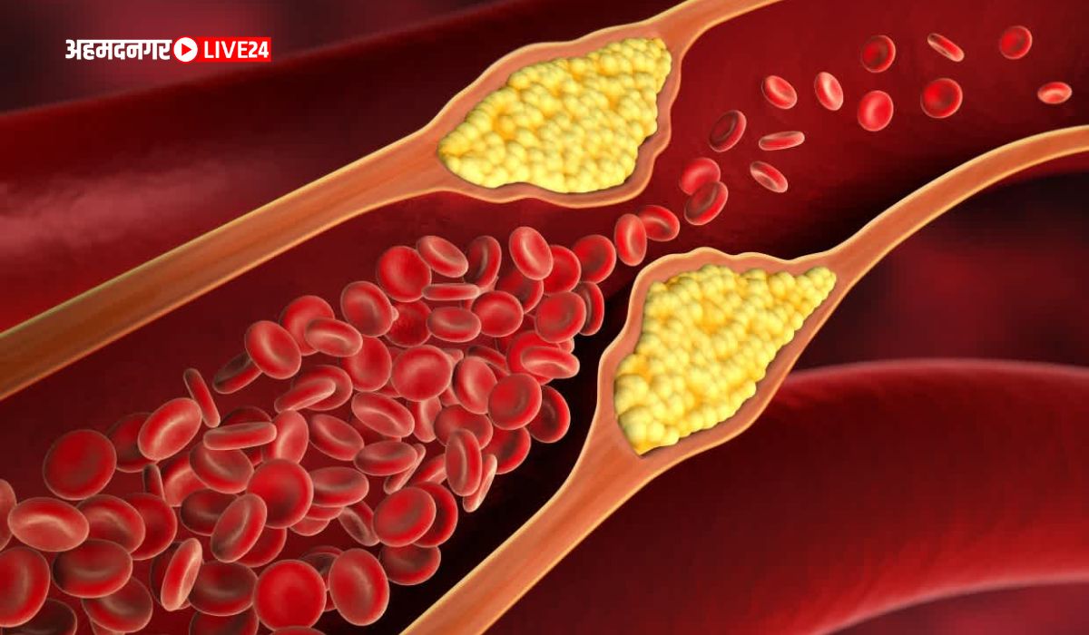 High Cholesterol