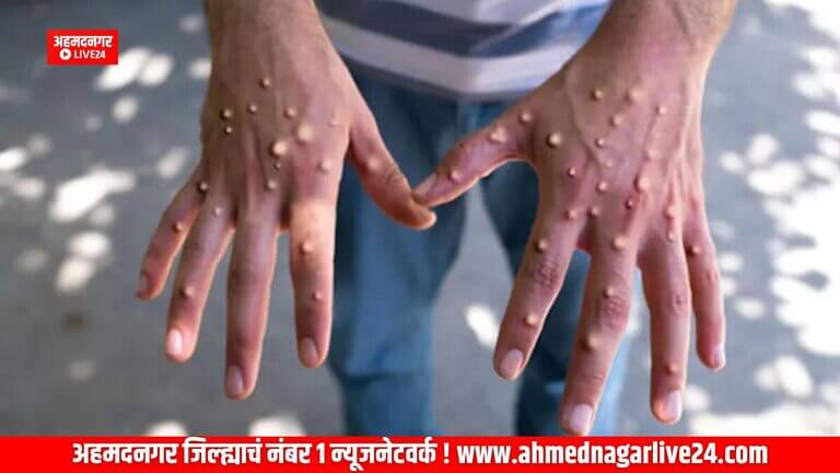 monkeypox